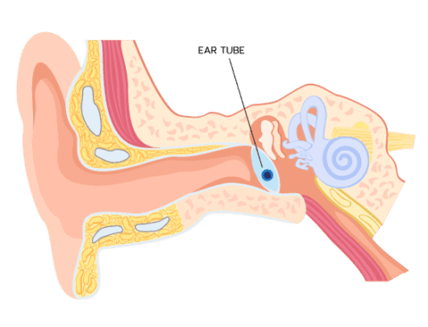 Ear Tubes | Ear, Nose & Throat Care Center