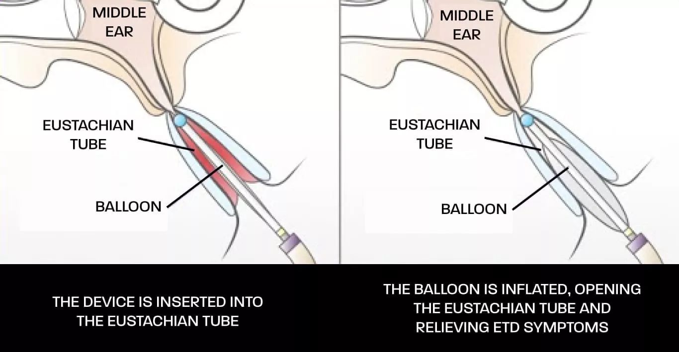 Eustachian Tube Dysfunction Ear Nose Throat Care Center Eustachian Tube Dysfunction Ear Nose Throat Care Center