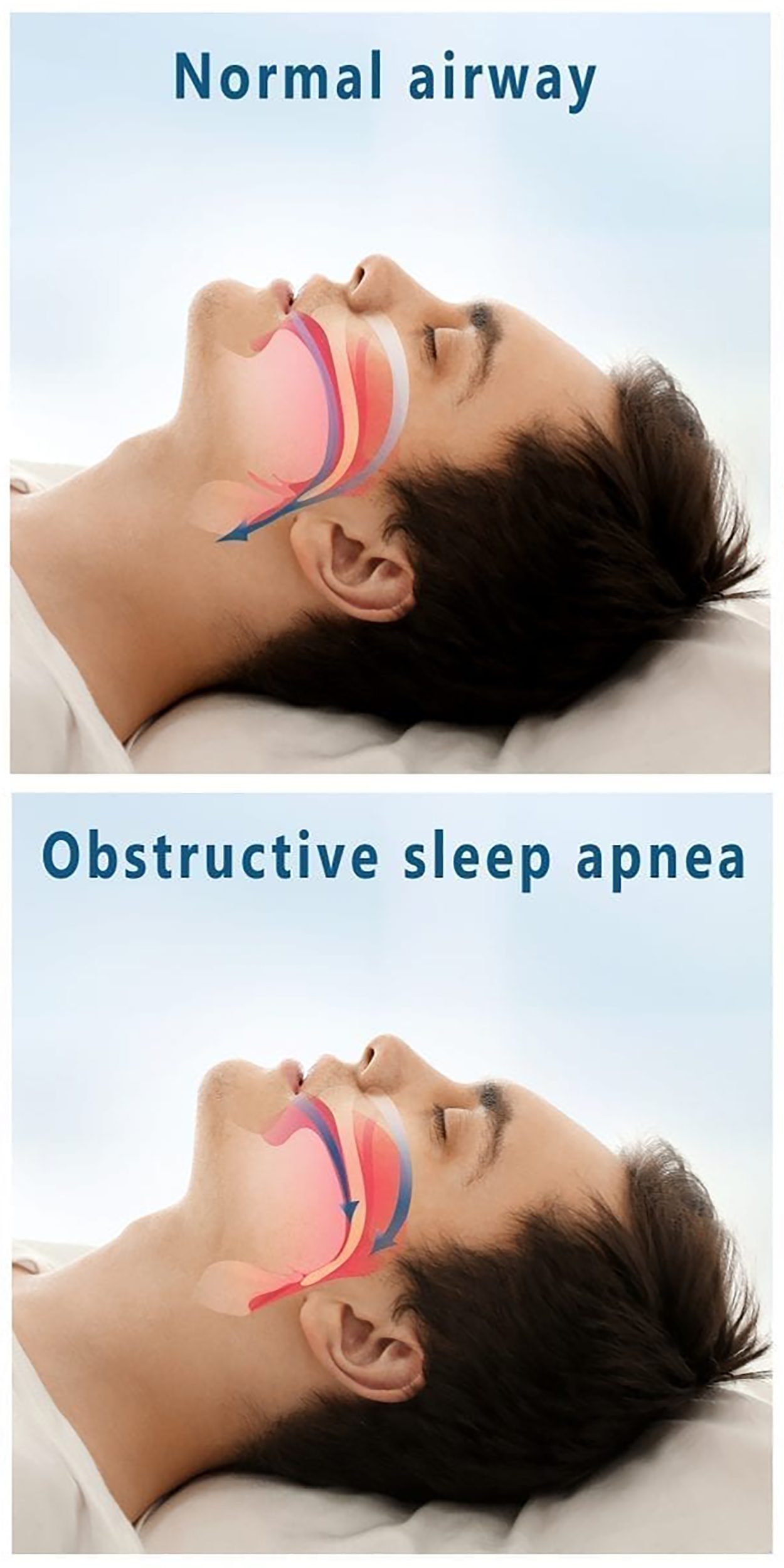 Sleep Apnea Ear Nose And Throat Care Center 3832