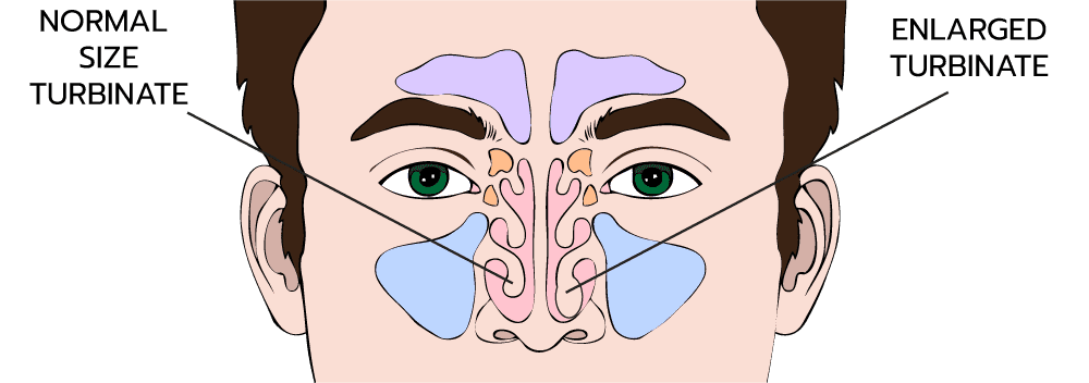 Neuromark device